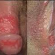 Illustration for article titled pengobatan herpes dengan lidah buaya